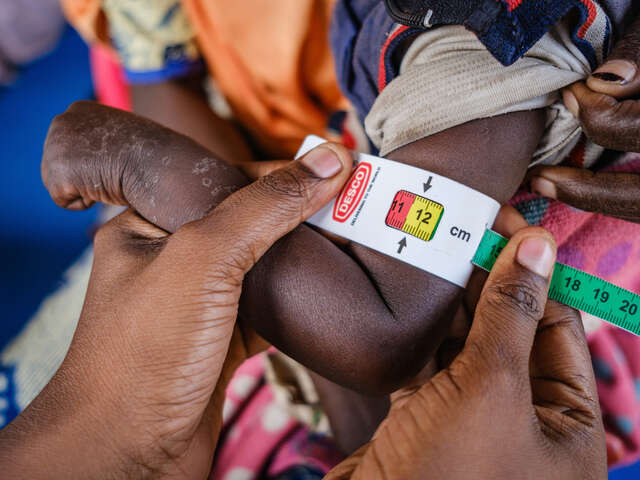 A severely malnourished child's arm being measured with a measuring taoe